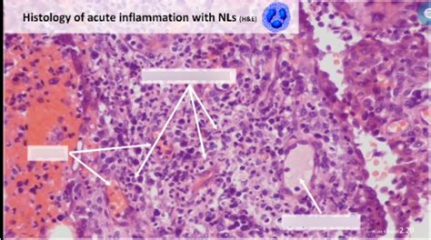 Acute inflammation histology Diagram | Quizlet