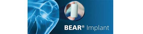 Miach Orthopaedics Launches BEAR® Implant Registry Study - Ortho Spine News