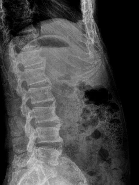 Diffuse idiopathic skeletal hyperostosis | Radiology Reference Article | Radiopaedia.org ...