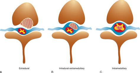 TUMORS OF THE SPINAL CORD | Neupsy Key