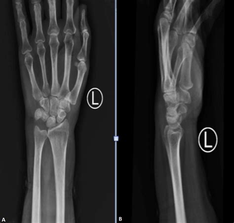 Cureus | Tuberculosis of the Left Wrist Joint and Spine