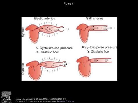 Arterial stiffness and pulse pressure in CKD and ESRD - ppt download