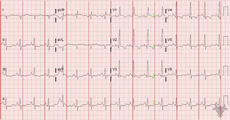 Right Heart Strain | ECG Stampede