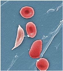 Sickle cell disease - Wikipedia