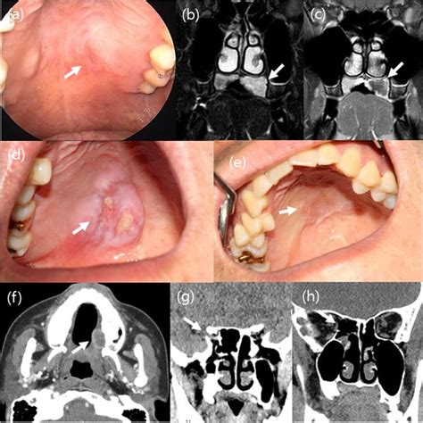 Clinical summary of 4 cases of necrotizing sialometaplasia (NSM ...