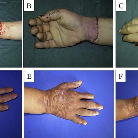 Total hand degloving injury (Case 1). (A) Before surgery. (B) Palm side ...