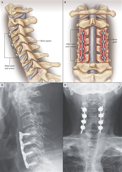 Cervical Spondylosis