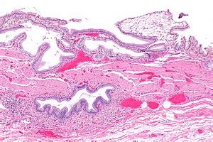 Chronic cholecystitis - Libre Pathology