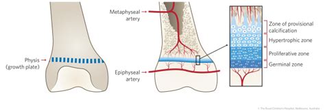 Fracture Education : Physeal (growth plate) injuries