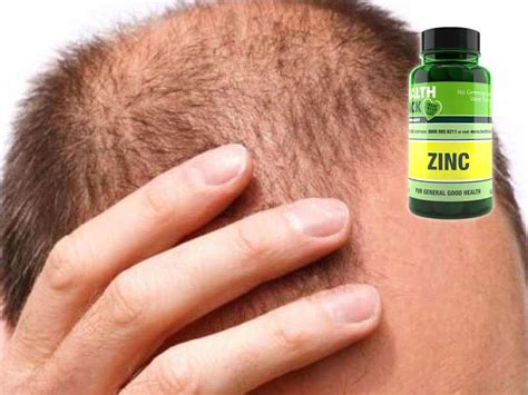 Should We Take Zinc For Hair Loss? Read This First!