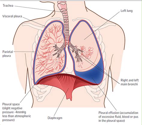 Pigtail catheter의 구조 (어떻게 생긴 녀석이지?) : 네이버 블로그