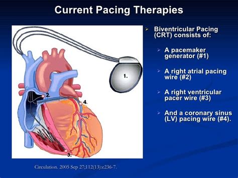 PPT for cardiac pacing