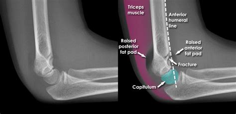 Supracondylar Fracture X Ray