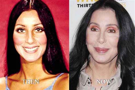 Cher plastic surgery 1 | Cher plastic surgery, Celebrities then and now