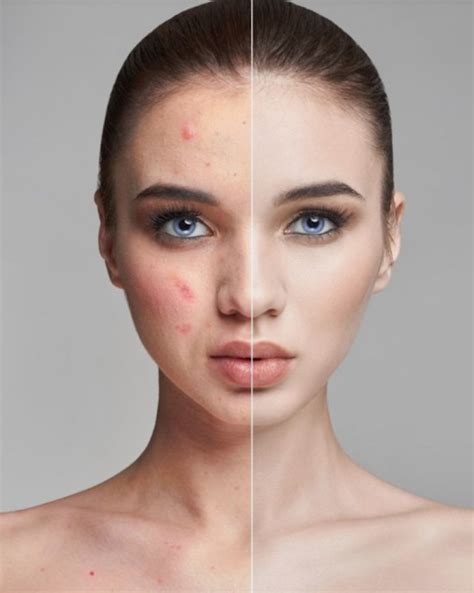 ACNE TREATMENT OPTIONS - Beauty Trends