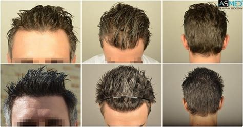 Norwood 2 Hair Transplantation Results | Asmed Hair Transplant