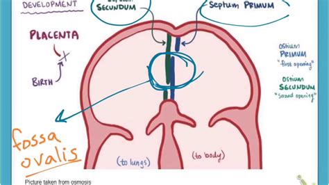 Left to right shunt (atrial septal defect) - YouTube