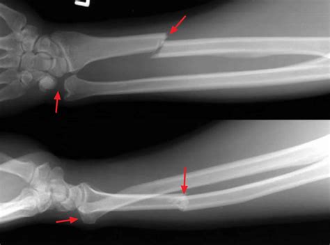 Galeazzi Fracture Classification