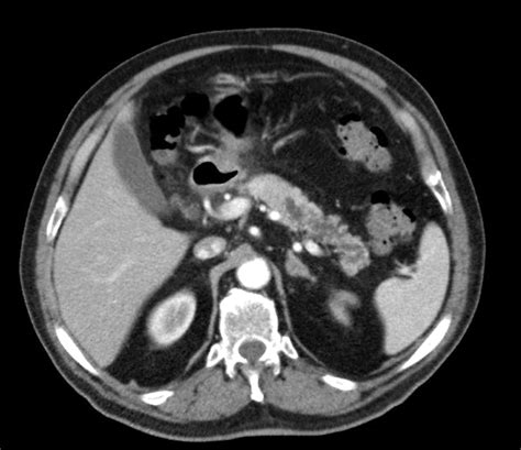 CT: dilated Wirsung duct in pancreatic body and tail. | Download ...