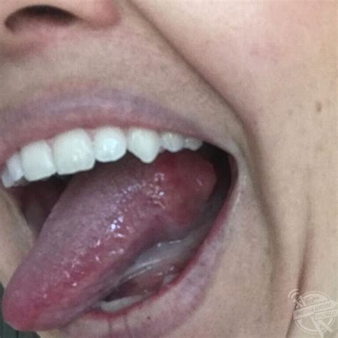 This Mum Had A Shock When A Bump On Her Tongue Ended Up Being Cancer ...