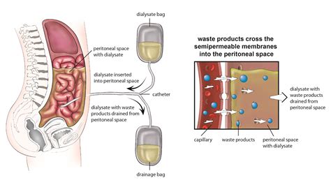 Use the form below to delete this Peritoneal Dialysis image from our index. Description from ...