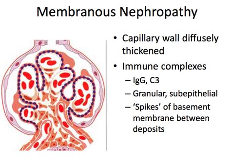 Glomerulonephritis, Membranous; Heymann Nephritis; Membranous Glomerulopathy; Nephropathy ...