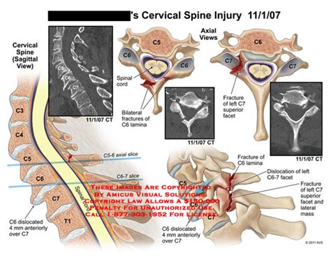 AMICUS Illustration of amicus,injury,cervical,spine,vertebrae,CT,C6 ...