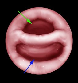 Zenker's Diverticulum Endoscopic Treatment Confusion | Fauquier ENT Blog