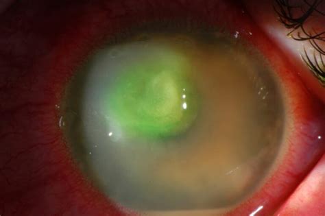 Corneal Ulcers | Wills Eye Hospital