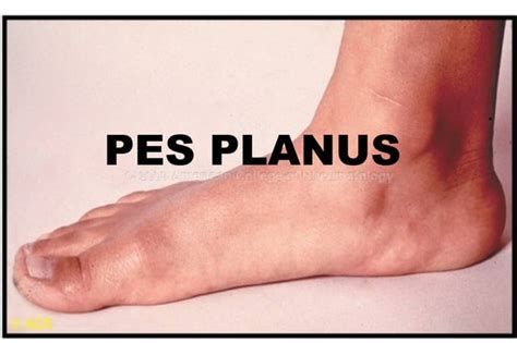 Pes Planus (Flat Foot): Causes, Symptoms, Diagnosis and Treatment | PPT