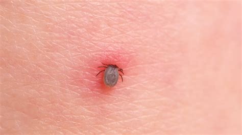 How to Treat a Tick Bite Correctly, According to Dermatologists