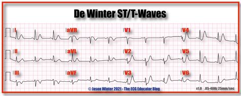 ECG Educator Blog : De Winters T waves