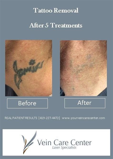 How Effective is Laser Tattoo Removal? | Laser Specialists