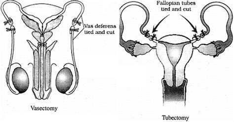 Vasectomy And Tubectomy Diagram