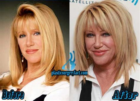 Suzanne Somers Plastic Surgery Before and After