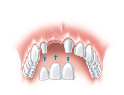 Tips to replace missing teeth | Blue Court Dental Centre, Harrow