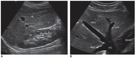 Liver Ultrasound Anatomy