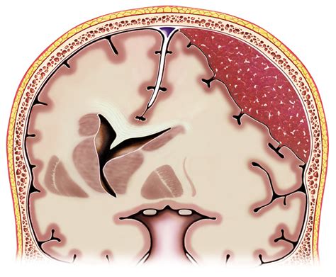 Subdural Hematoma - Harvard Health