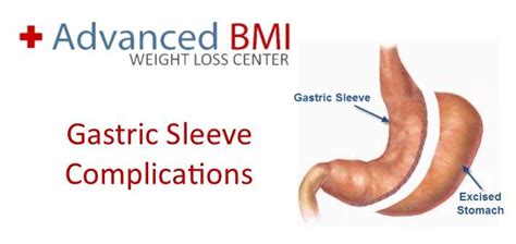 Gastric Sleeve Complications in Lebanon - Dr Nagi Jean Safa