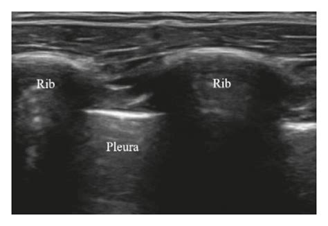 Ultrasound Guided Intercostal Block