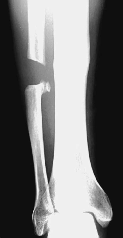 X-rays of the operated fibula taken after 6 months did not show any... | Download Scientific Diagram