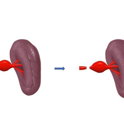 Surgical and endovascular techniques for aneurysm repair. a Surgical ...