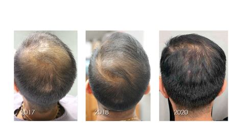 PRP Hair Restoration — MesoHealth