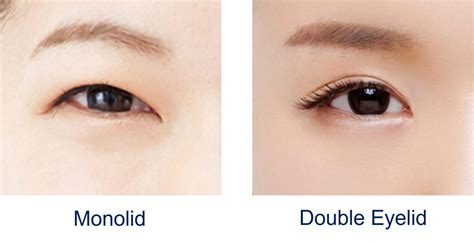 Ideal Candidate Guide for Double Eyelid Surgery in Singapore