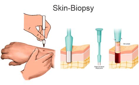 JAJU – Skin Biopsy | Hospital and Health