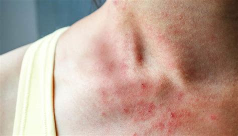 Skin Problems That are Caused Due To Deficiency of Vitamin B-12 - lifeberrys.com