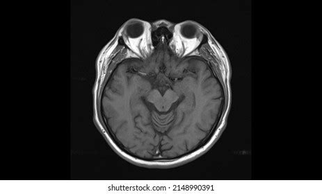 Normal Brain Anatomy Axial T1weighted Mri Stock Photo 2148990391 ...