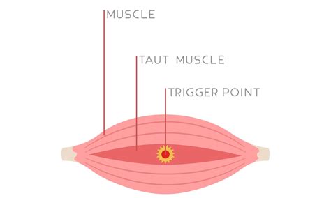 Dry Needling Near Me in St. Louis | Trigger Point Release | Axes ...