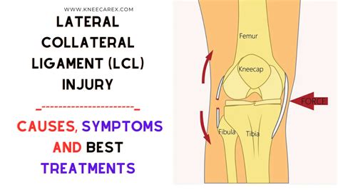 Lateral Collateral Ligament (LCL) Injury: Best Guide 2024