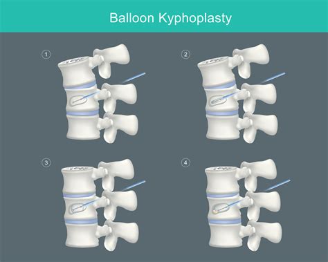 What Is Balloon Kyphoplasty? | PainScale